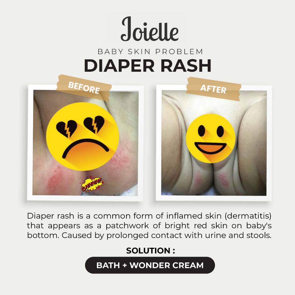 Combo Baby Bath + Wonder Cream (Diaper Rash)