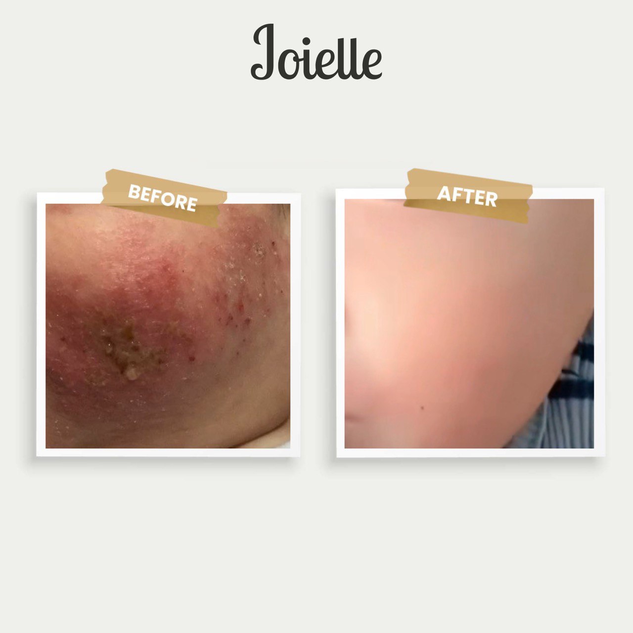 Joielle Complete Eczema Set