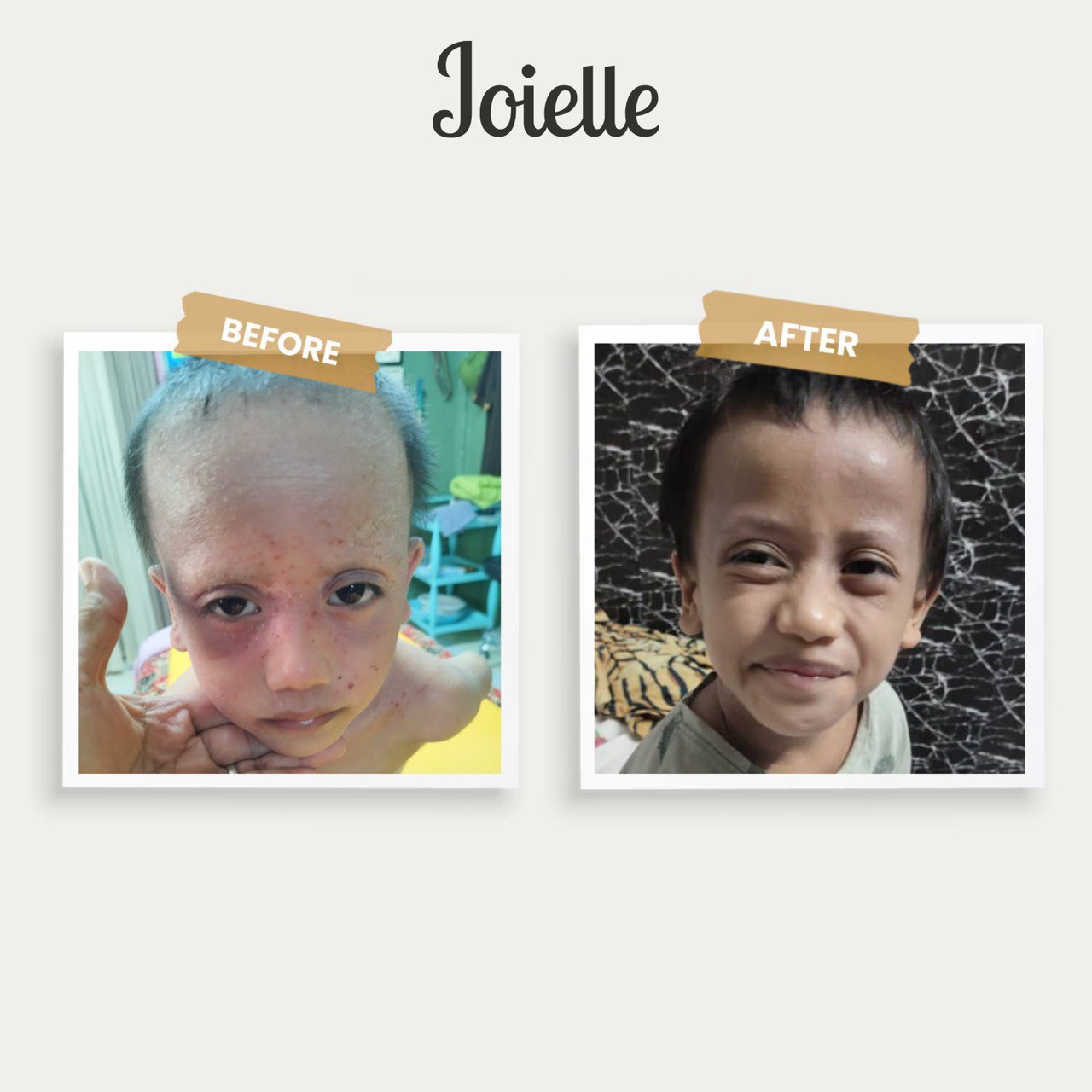 Joielle Complete Eczema Set